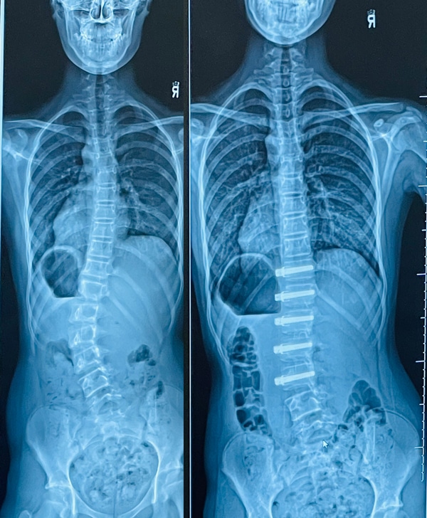 Two x-rays of a woman's spine.