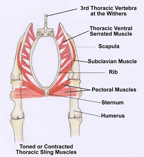 Illustration of a thorasic sling.